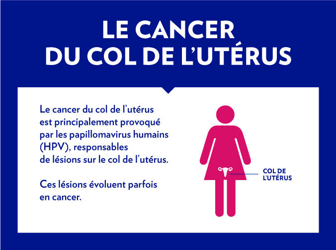 Le cancer du col de l’utérus est principalement provoqué par les papillomavirus humains (HPV), responsables de lésions sur le col de l’utérus. Ces lésions évoluent parfois en cancer.